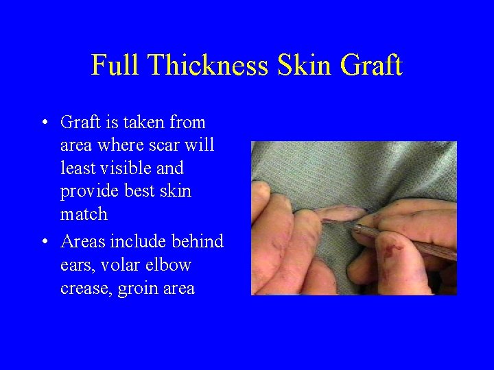 Full Thickness Skin Graft • Graft is taken from area where scar will least