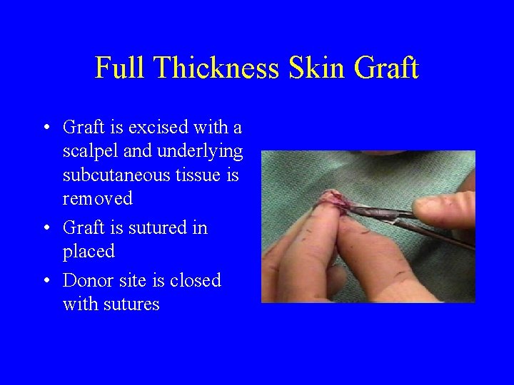 Full Thickness Skin Graft • Graft is excised with a scalpel and underlying subcutaneous