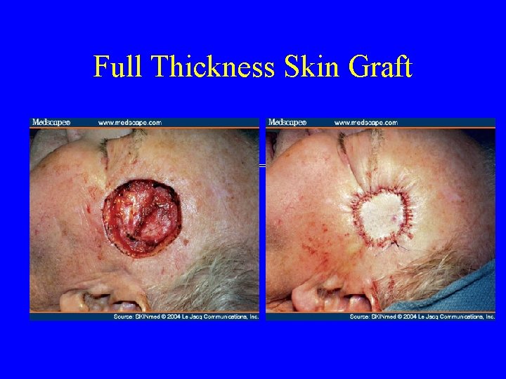 Full Thickness Skin Graft 