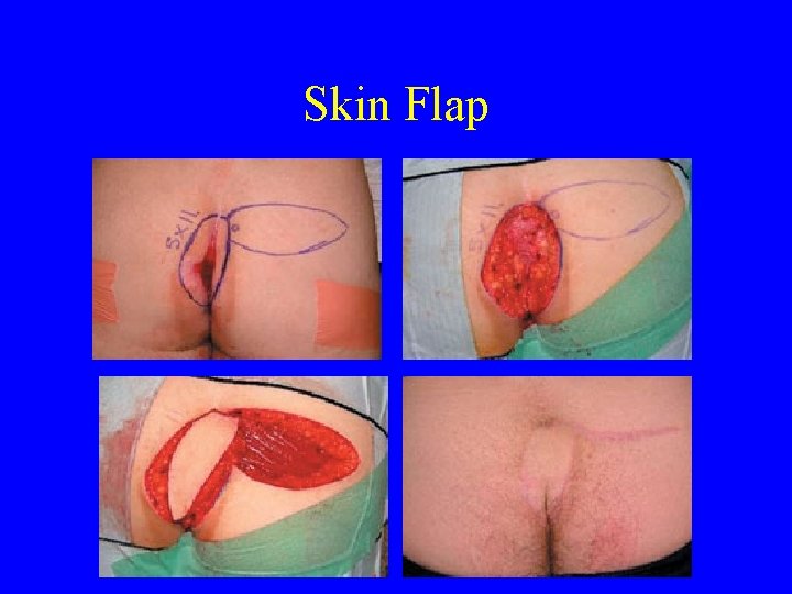 Skin Flap 
