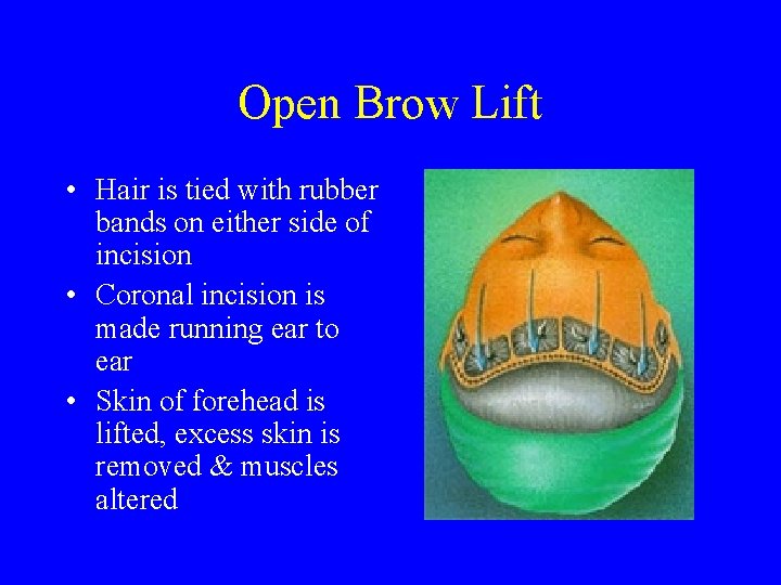 Open Brow Lift • Hair is tied with rubber bands on either side of