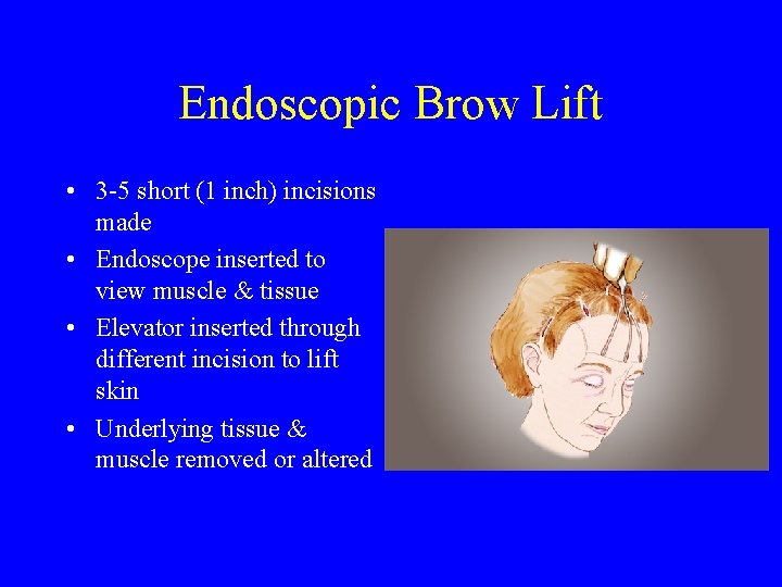 Endoscopic Brow Lift • 3 -5 short (1 inch) incisions made • Endoscope inserted