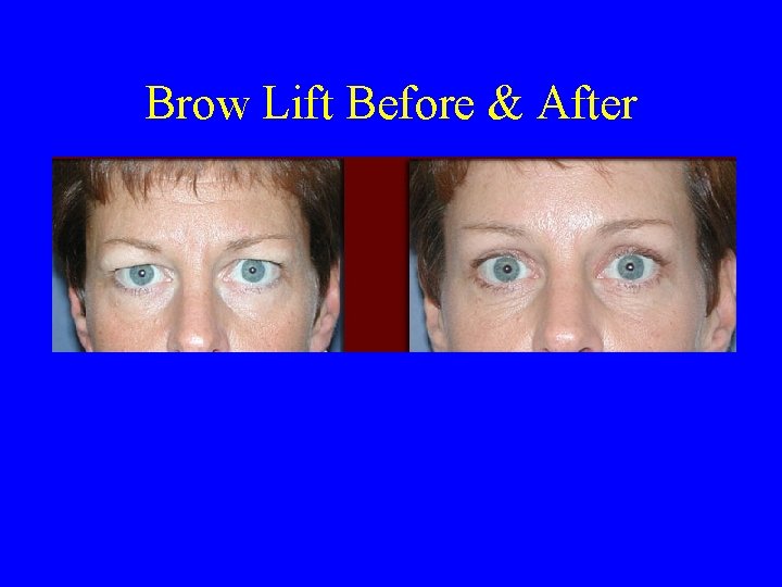 Brow Lift Before & After 