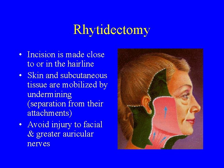 Rhytidectomy • Incision is made close to or in the hairline • Skin and
