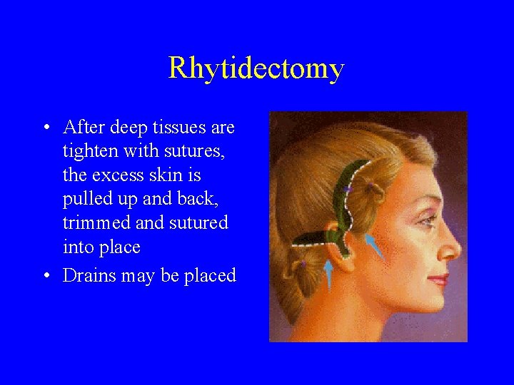 Rhytidectomy • After deep tissues are tighten with sutures, the excess skin is pulled