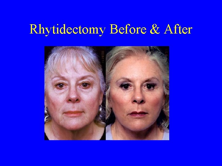 Rhytidectomy Before & After 