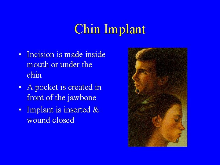 Chin Implant • Incision is made inside mouth or under the chin • A