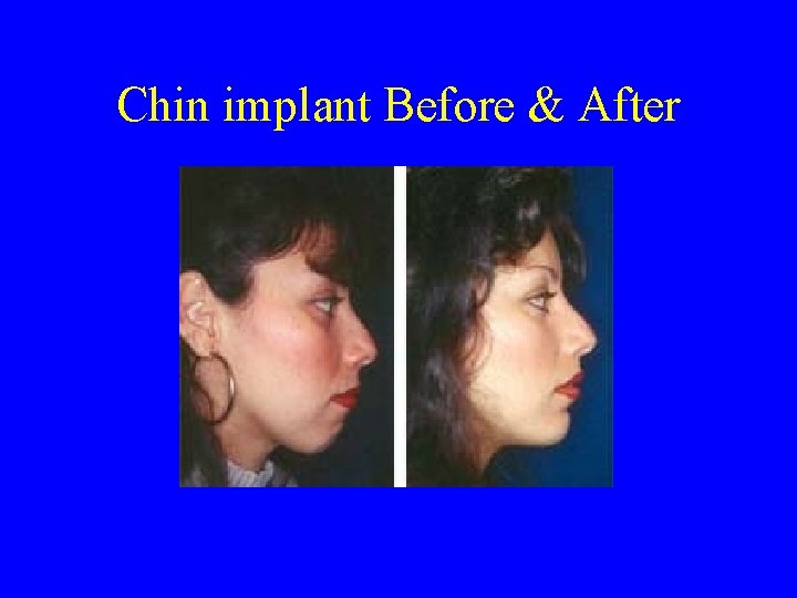 Chin implant Before & After 