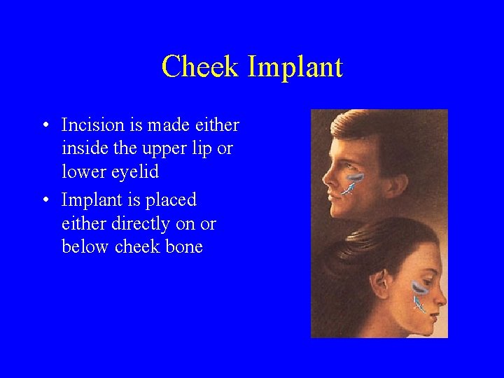 Cheek Implant • Incision is made either inside the upper lip or lower eyelid