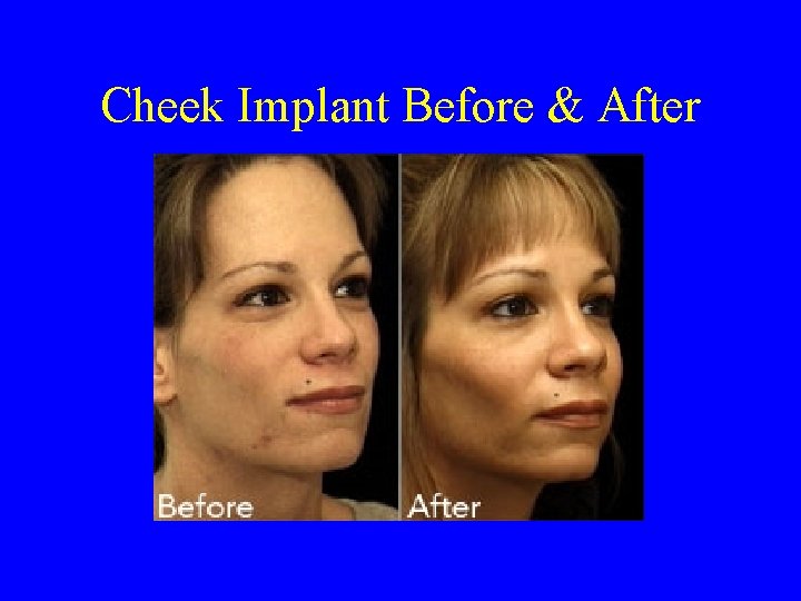 Cheek Implant Before & After 