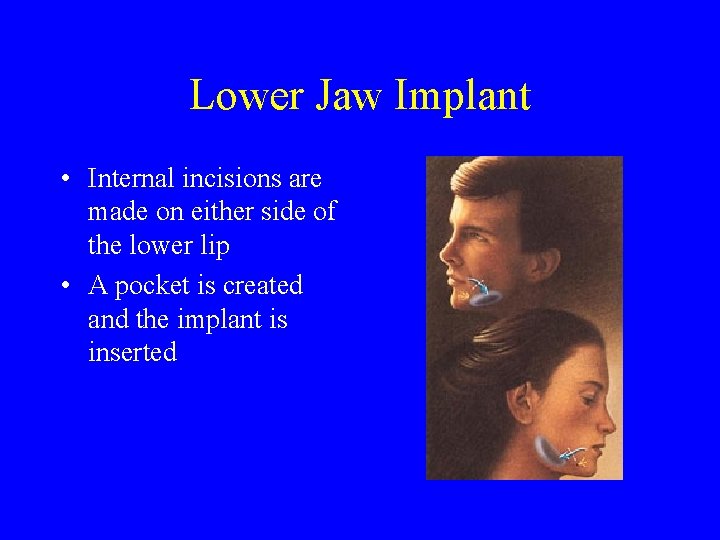 Lower Jaw Implant • Internal incisions are made on either side of the lower