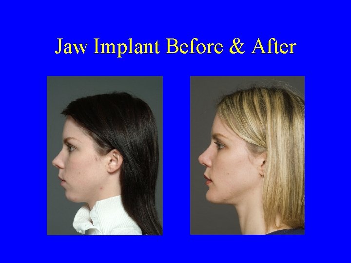 Jaw Implant Before & After 
