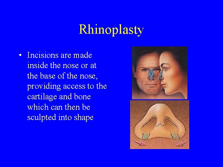 Rhinoplasty • Incisions are made inside the nose or at the base of the