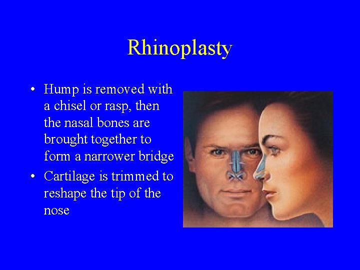 Rhinoplasty • Hump is removed with a chisel or rasp, then the nasal bones