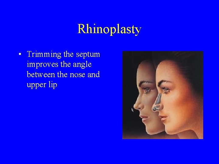 Rhinoplasty • Trimming the septum improves the angle between the nose and upper lip