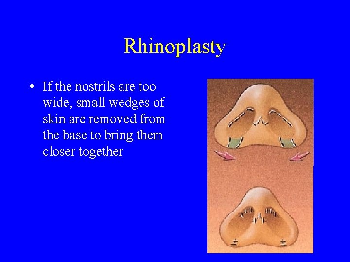 Rhinoplasty • If the nostrils are too wide, small wedges of skin are removed