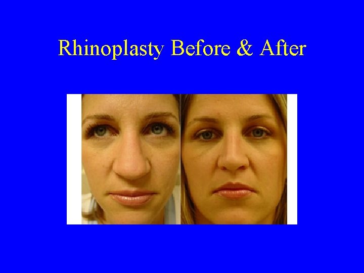 Rhinoplasty Before & After 