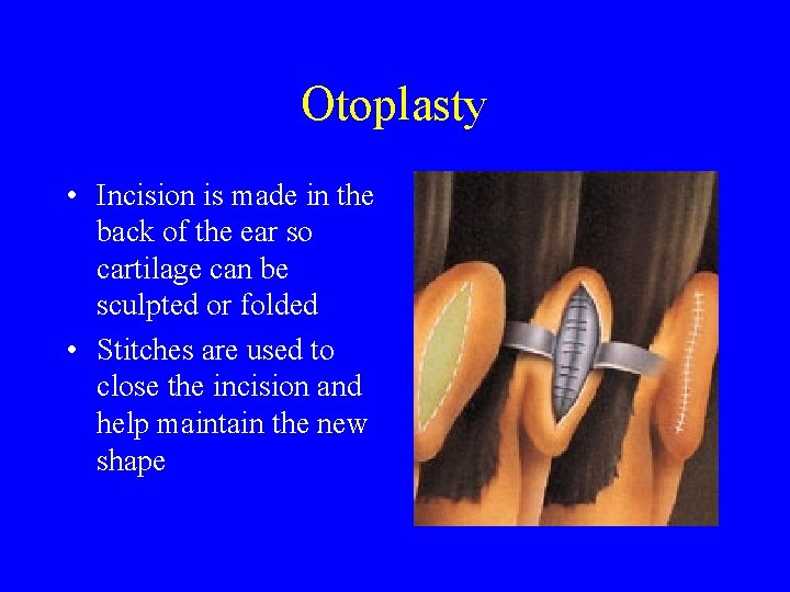 Otoplasty • Incision is made in the back of the ear so cartilage can