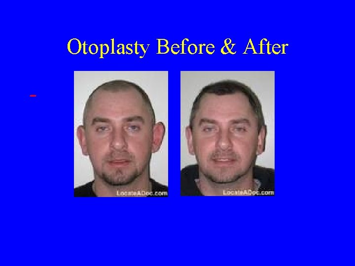 Otoplasty Before & After 