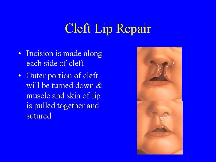 Cleft Lip Repair • Incision is made along each side of cleft • Outer