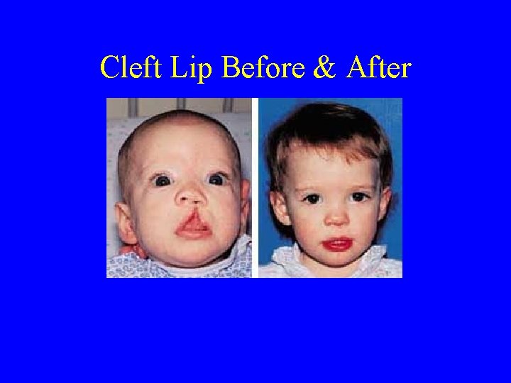 Cleft Lip Before & After 