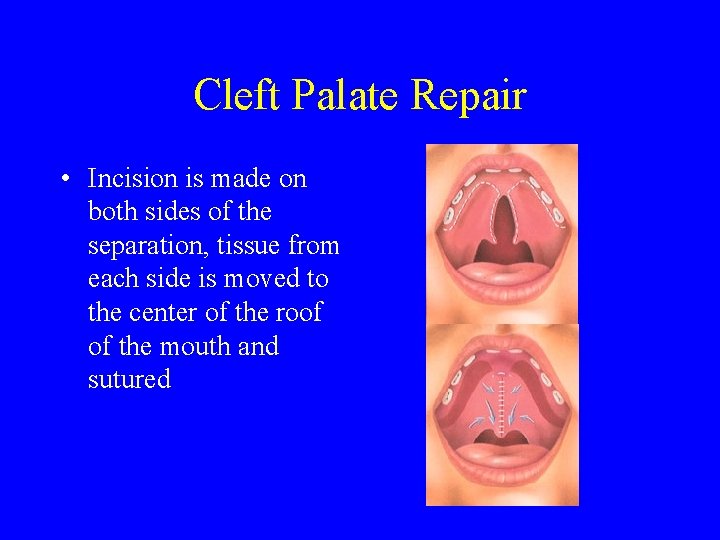 Cleft Palate Repair • Incision is made on both sides of the separation, tissue