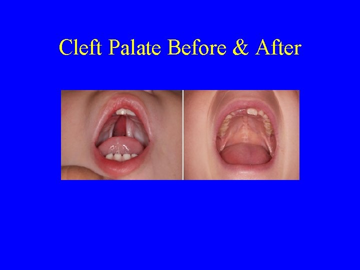 Cleft Palate Before & After 