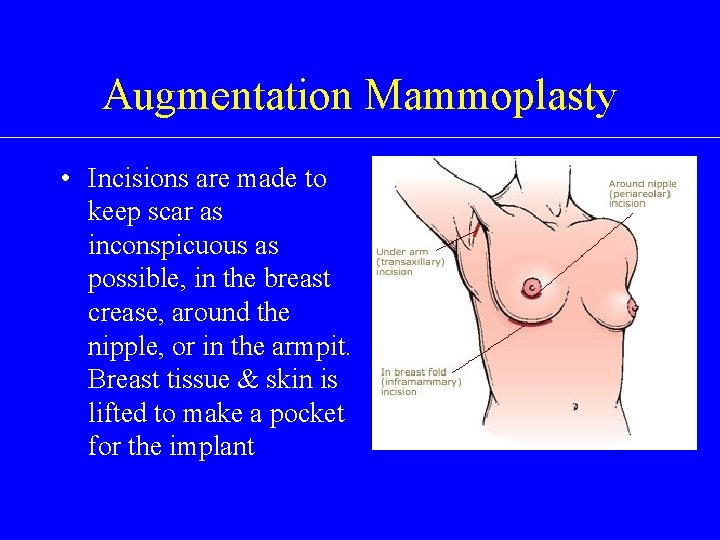 Augmentation Mammoplasty • Incisions are made to • keep scar as inconspicuous as possible,