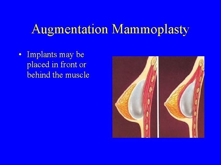 Augmentation Mammoplasty • Implants may be placed in front or behind the muscle 