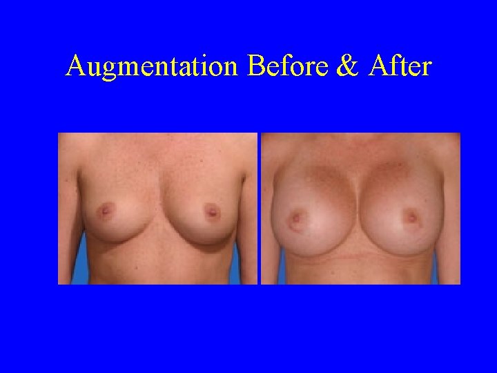Augmentation Before & After 