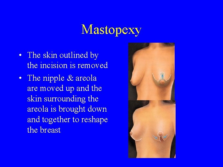 Mastopexy • The skin outlined by the incision is removed • The nipple &