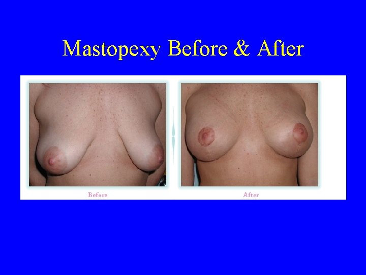 Mastopexy Before & After 