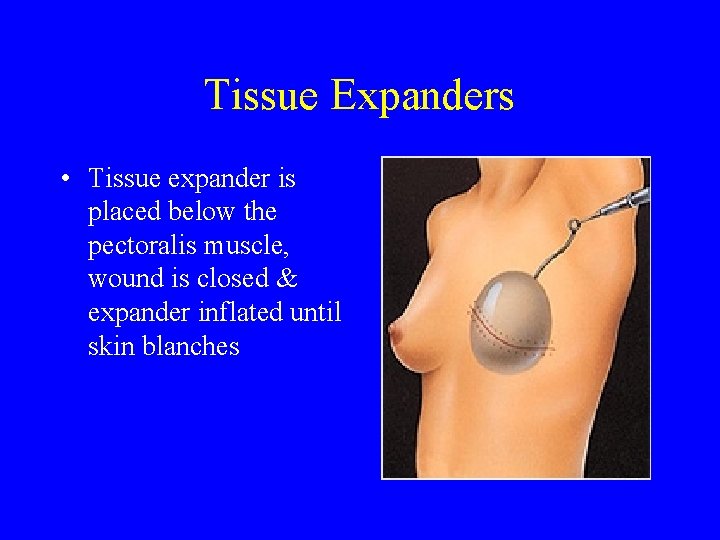 Tissue Expanders • Tissue expander is placed below the pectoralis muscle, wound is closed