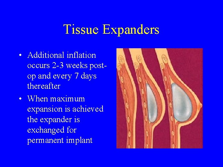 Tissue Expanders • Additional inflation occurs 2 -3 weeks postop and every 7 days
