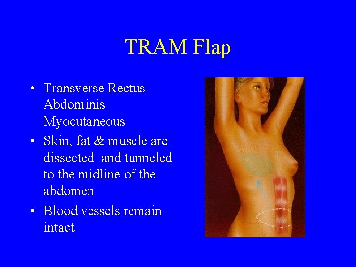 TRAM Flap • Transverse Rectus Abdominis Myocutaneous • Skin, fat & muscle are dissected