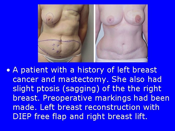 Diep Flap • A patient with a history of left breast cancer and mastectomy.