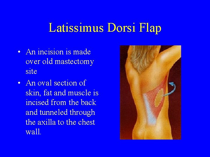 Latissimus Dorsi Flap • An incision is made over old mastectomy site • An