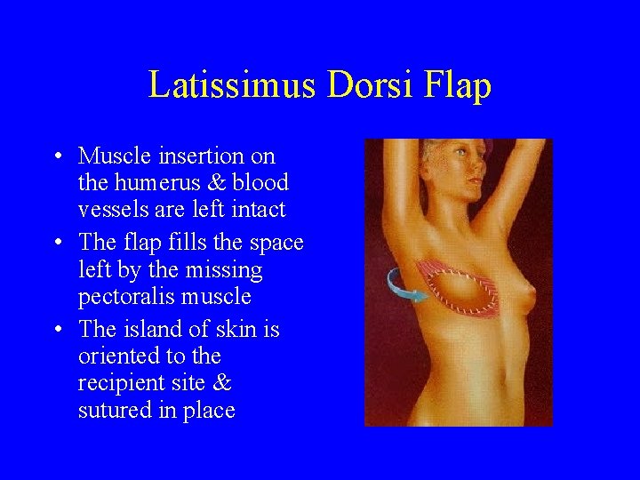 Latissimus Dorsi Flap • Muscle insertion on the humerus & blood vessels are left