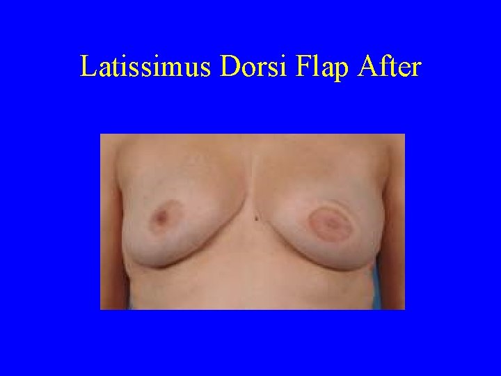 Latissimus Dorsi Flap After 