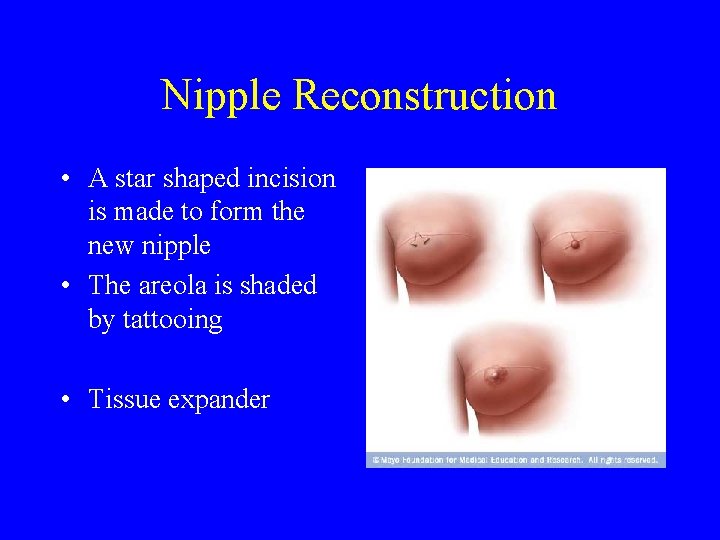 Nipple Reconstruction • A star shaped incision is made to form the new nipple