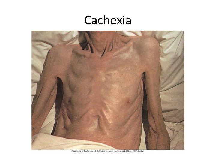 Cachexia 