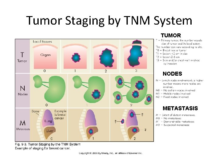 Tumor Staging by TNM System TUMOR NODES METASTASIS 