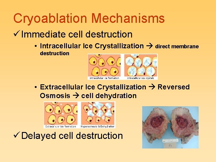 Cryoablation Mechanisms ü Immediate cell destruction • Intracellular Ice Crystallization direct membrane destruction •