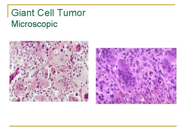 Giant Cell Tumor Microscopic 