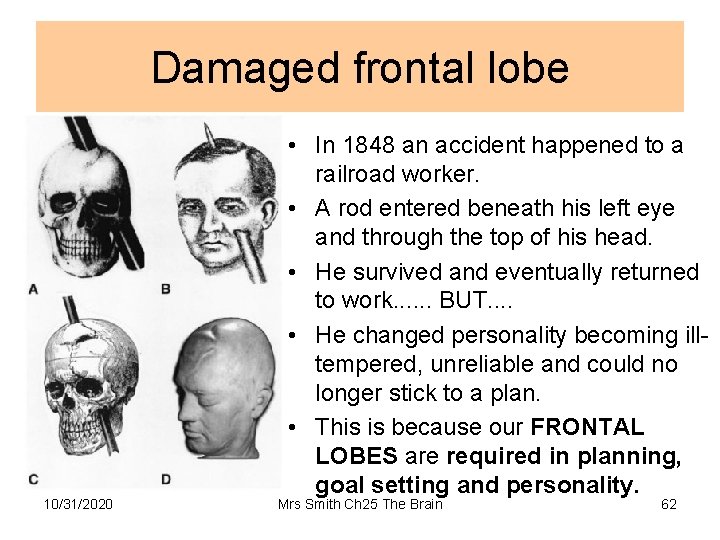 Damaged frontal lobe 10/31/2020 • In 1848 an accident happened to a railroad worker.