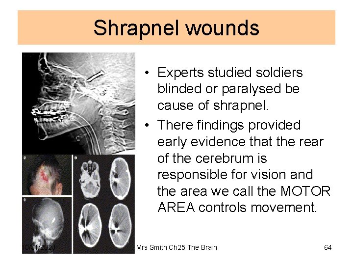 Shrapnel wounds • Experts studied soldiers blinded or paralysed be cause of shrapnel. •