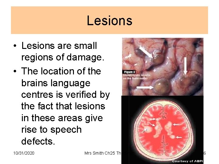 Lesions • Lesions are small regions of damage. • The location of the brains