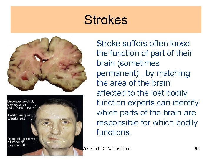 Strokes Stroke suffers often loose the function of part of their brain (sometimes permanent)