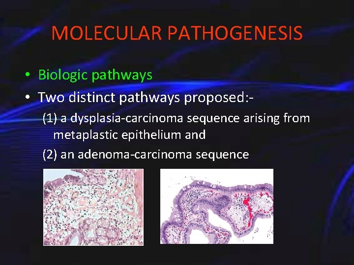 MOLECULAR PATHOGENESIS • Biologic pathways • Two distinct pathways proposed: (1) a dysplasia-carcinoma sequence