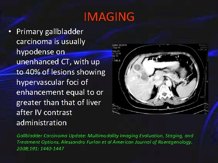 IMAGING • Primary gallbladder carcinoma is usually hypodense on unenhanced CT, with up to